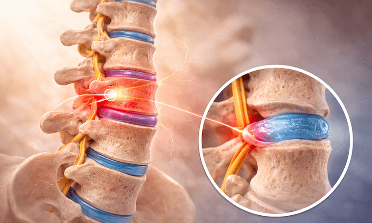 medziobratlové plotenky